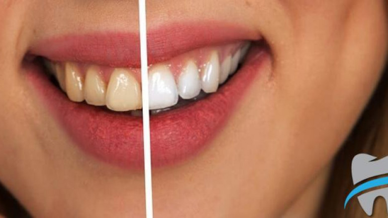 Zoom Teeth Whitening Waterloo