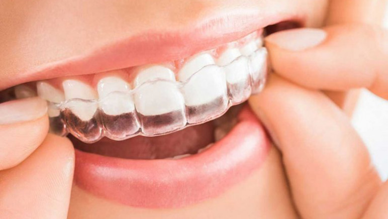 Advantages of Invisalign Over Traditional Braces