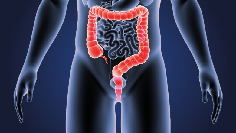 Cancer Drugs for Colon and Rectal Use Are Available To Treat Colon and Rectal Cancer