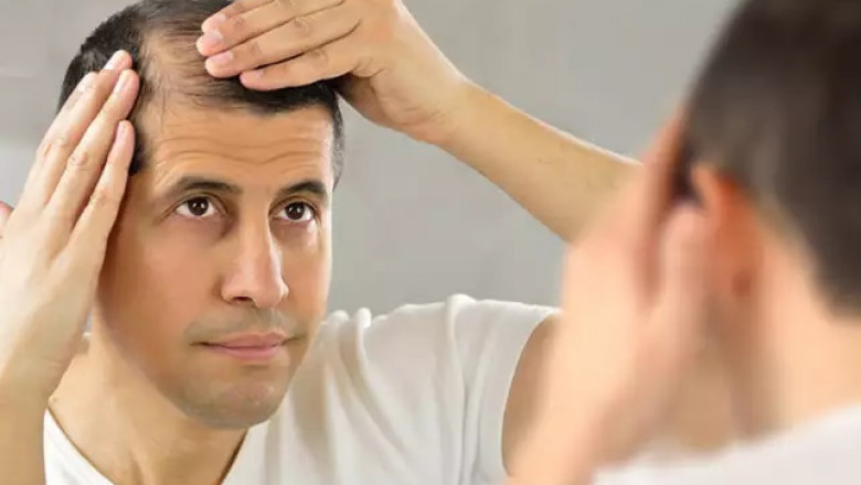 Is Hair Transplant A Long Lasting Procedure?