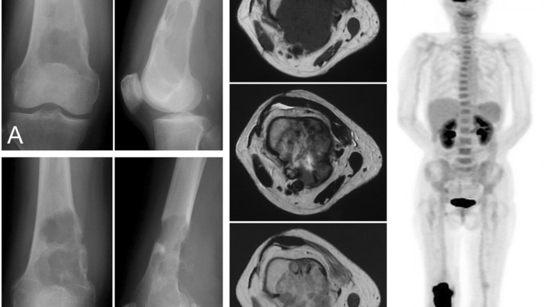 Angiosarcomas treatment market remedies