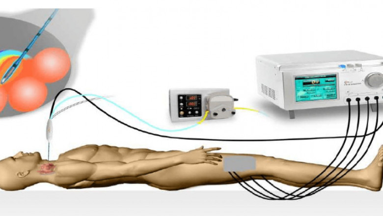 Ablation Devices Market Analysis and Insights