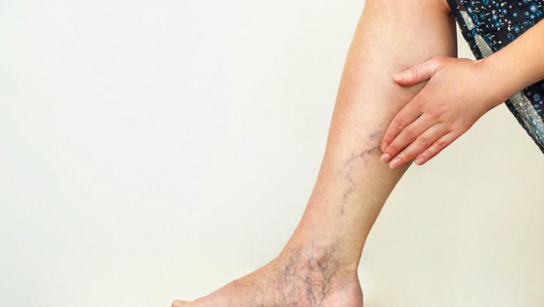 How Do You Treat Varicose Veins?