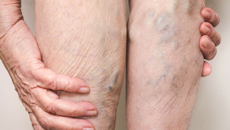 Is It Important To Know About The Available Treatment Options For Your Veins?
