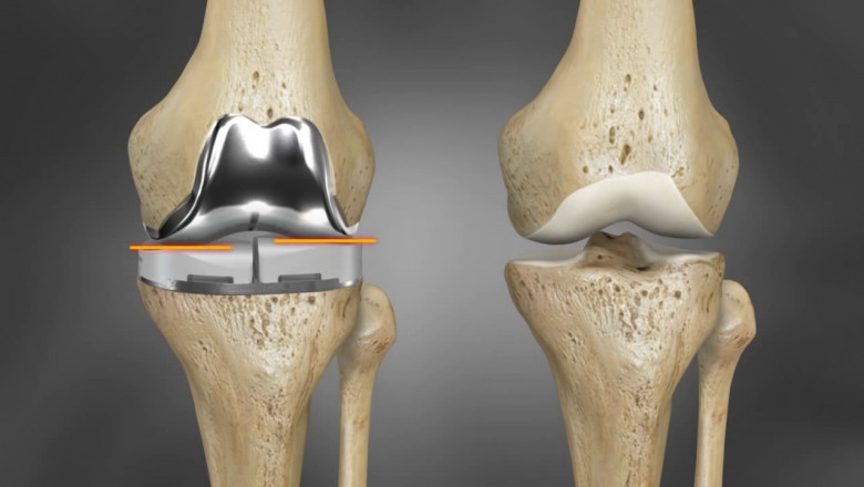Knee Implants Market Overview