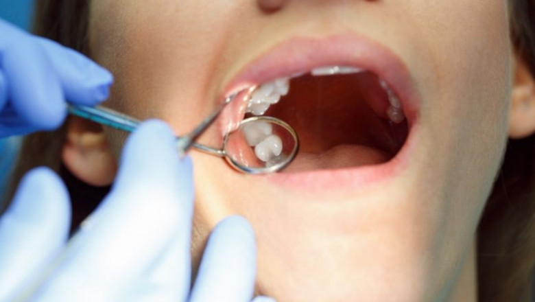 How Is A Root Canal Performed?