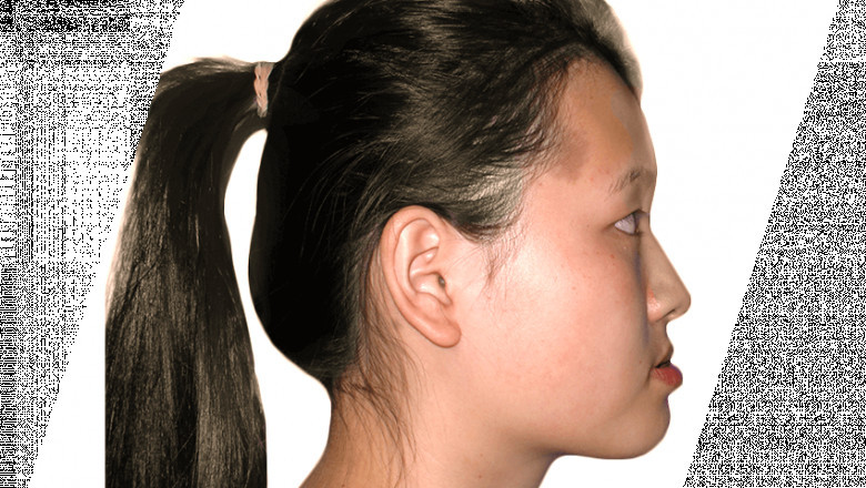 How Long Does Neck Liposuction Last?