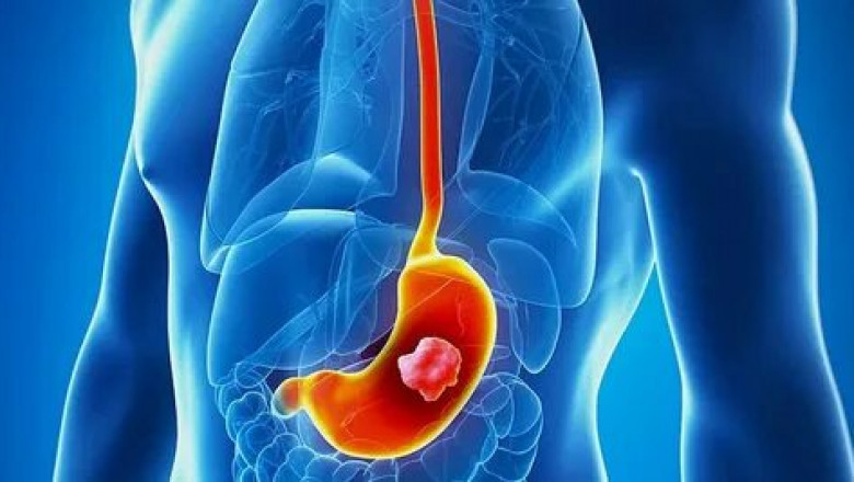 Paracentesis is the most common method in malignant ascites treatment