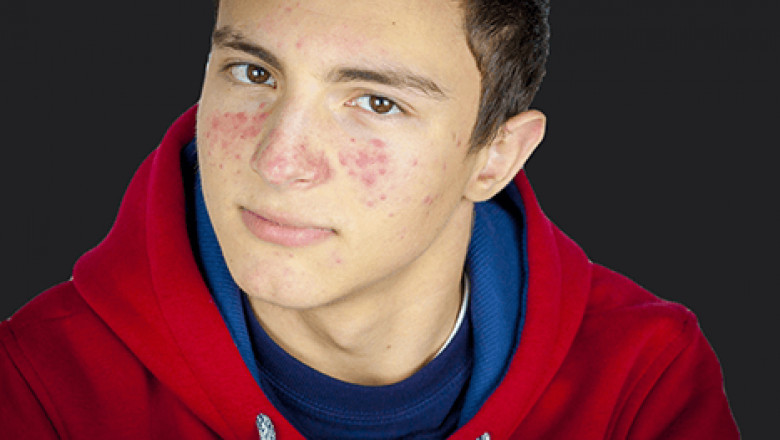 Acne Behandeling Voor Een Gezonde En Stralende Huid