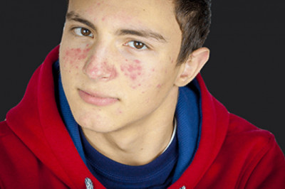 Acne Behandeling Voor Een Gezonde En Stralende Huid