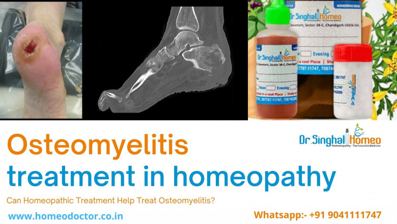 Can Homeopathic Treatment Help Treat Osteomyelitis?
