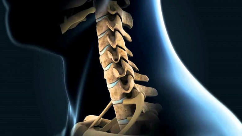 Cervical Total Disc Replacement Devices Preserve More Normal Neck Motion
