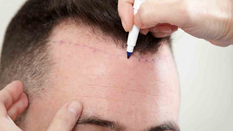 How To Choose The Best Hair Transplant Doctor in Jaipur?