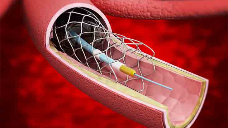 Vascular Stents Market 2022: Size, Share, Analysis and Forecast-2027