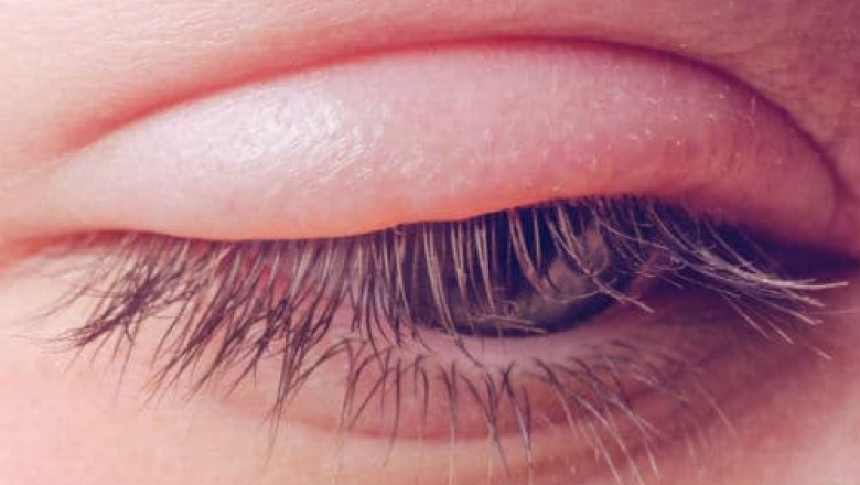 Dry Eye Syndrome - How to Locate Relief