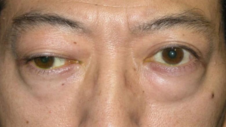 Myasthenia Gravis Market: Industry Analysis, Opportunity and Forecast to 2027