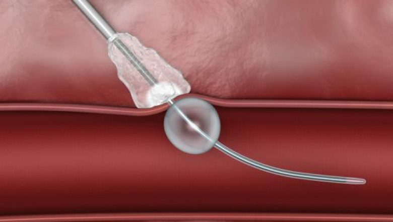 Vascular Closure Devices Market 2022: Size, Share, Analysis and Forecast-2027