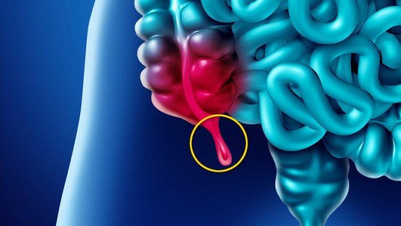 Appendiceal Cancer Treatment Market: Industry Analysis, Opportunity and Forecast to 2027