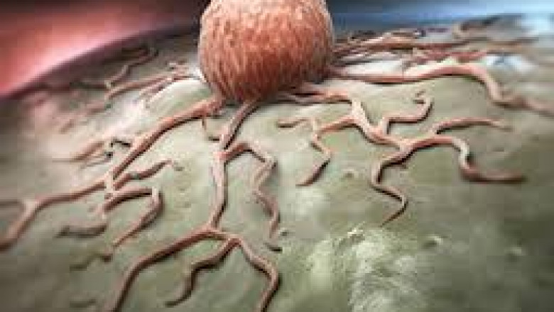 Desmoid Tumors Market - Global Industry Analysis by Size, Share and Forecast 2022 – 2027