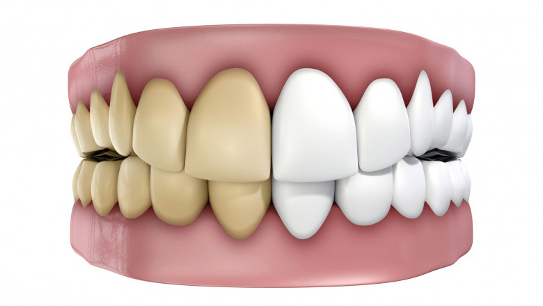 Stained Teeth from Braces