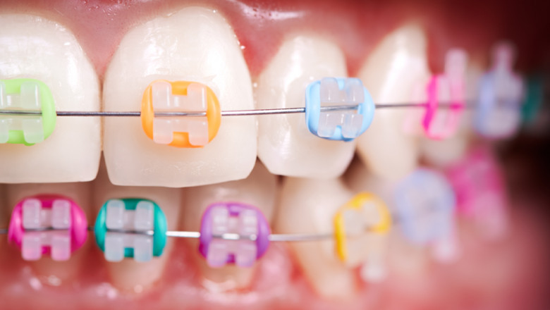 Why Do I Need An Orthodontist?