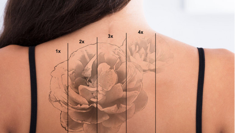 Tattoo Removal With Q-Switched Lasers