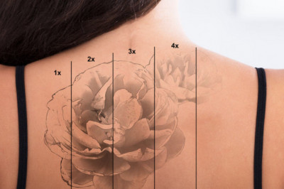 Tattoo Removal With Q-Switched Lasers