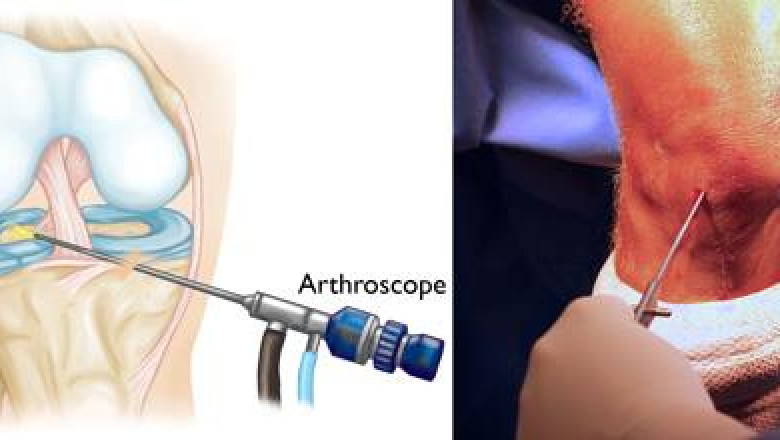 Knee Arthroscopy