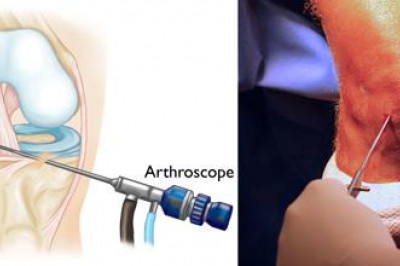 Knee Arthroscopy