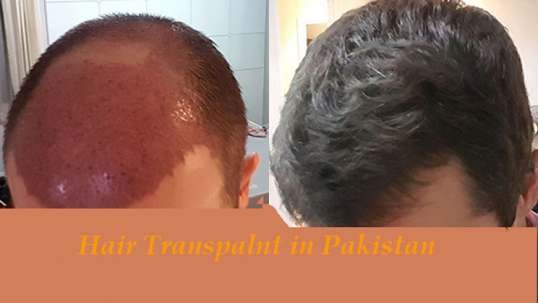 After Hair Surgery Necessary to Follow Surgeon Guidance