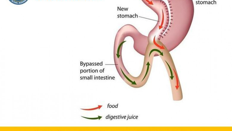 Best Mini Gastric Bypass Surgery at Indore-Laparoscopy-Center
