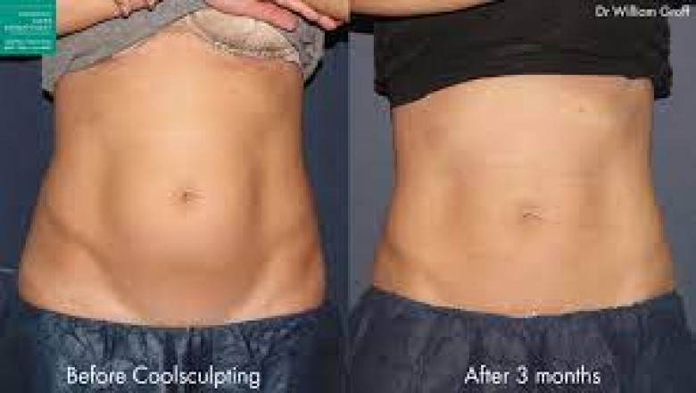 Body Contouring Market 2022 – Global Industry Market Report 2027
