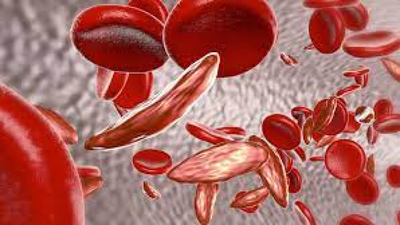 Global Hemoglobinopathy Market Size, Share & Trends Analysis Report, and Segment Forecasts, 2021-2028