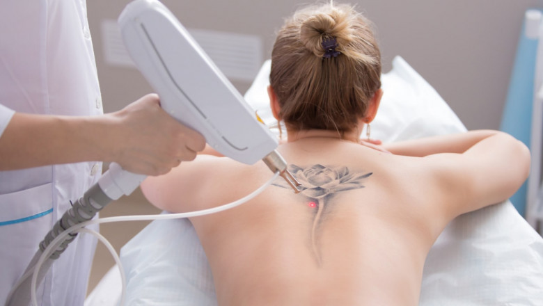 Permanent Laser Treatment for Tattoo Removal in Dubai