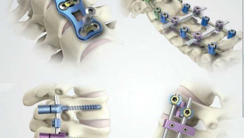 Spinal Implants Market Share: Industry Analysis, Opportunity and Forecast to 2027