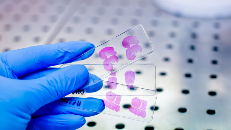 Anatomic Pathology Market Share Expected to Rise with Double-Digit CAGR by 2030