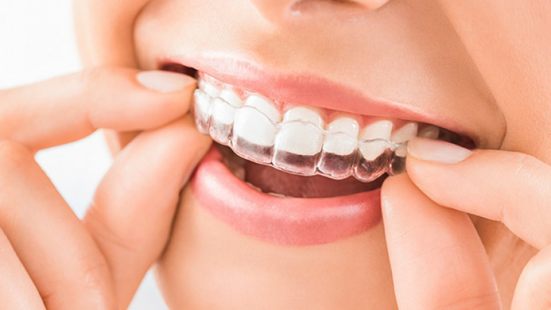 Global Dental Night Guard Market Share, Growth, Size, Trends and Forecast 2022 - 2028