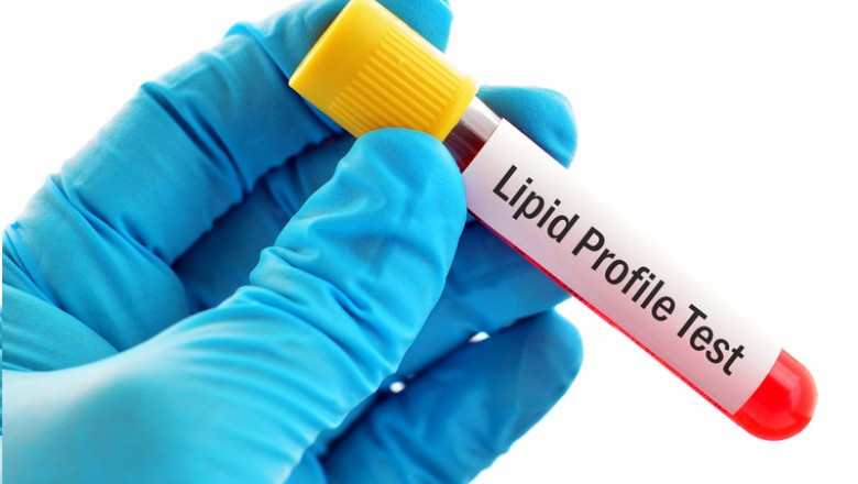 Lipid Testing Market Growth Strategies, Opportunity, Rising Trends and Revenue Analysis 2025