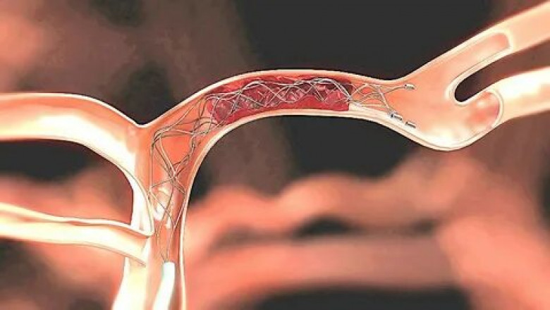 Mechanical Thrombectomy Devices Market size, key developments, and competitive information. 2022-2028| Research Informatic