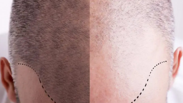 When Is a Hair Transplant The ideal Solution For You?