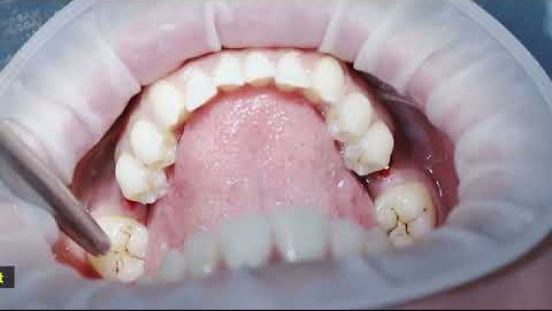 Dental Implants Specialist Los Angeles