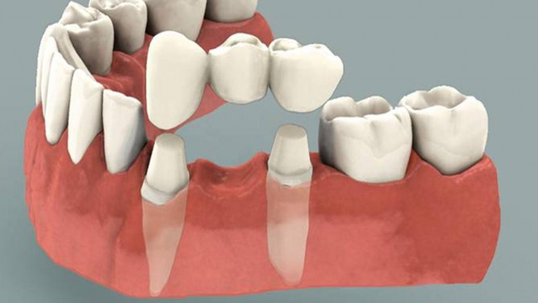 Dental bridge: Everything you need to know
