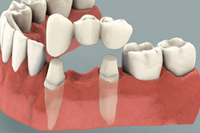 Dental bridge: Everything you need to know