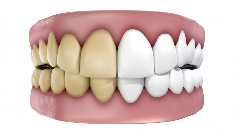 Facts about root canal therapy