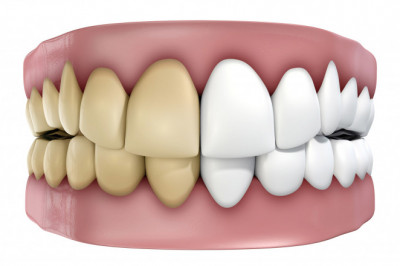 Facts about root canal therapy