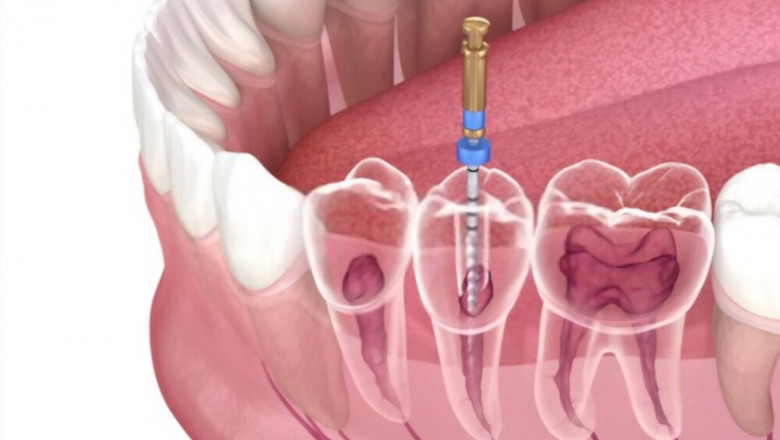 5 Signs Of Infection After Root Canal Treatment