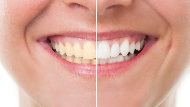 Cosmetic dentistry Liverpool NY