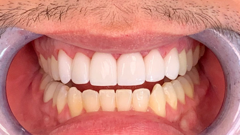 How Do I Know If I Need Veneers?