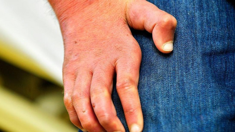 What Is Leprosy?