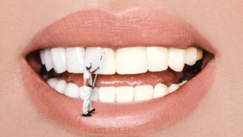 Whiten Your Yellow Smile in Tomball And Its Causes